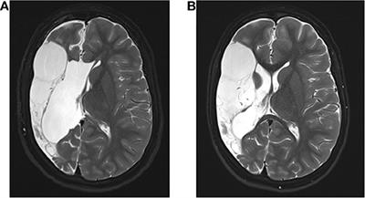 Case Report: Behavioral Disorder Following Hemispherotomy: A Valproate Effect?